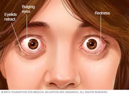 Image result for graves disease exophthalmos